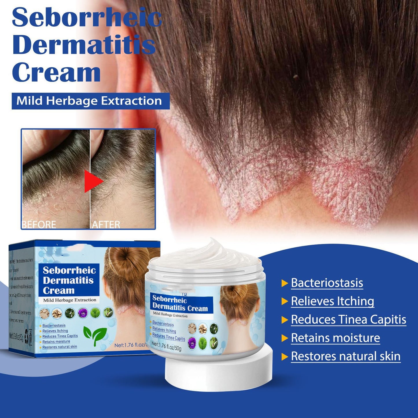 Creme gegen seborrhoische Haut, Kopfhautakne und Juckreiz