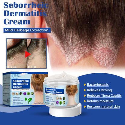 Creme gegen seborrhoische Haut, Kopfhautakne und Juckreiz