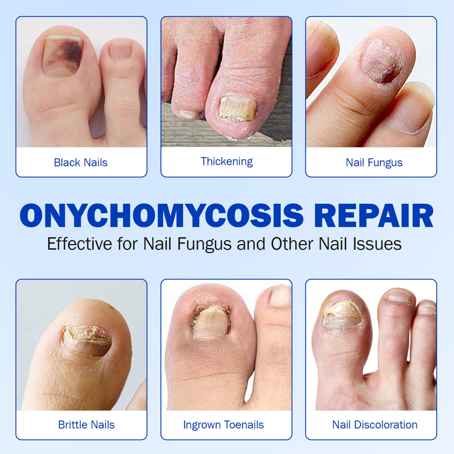 Fungal Nail Patches