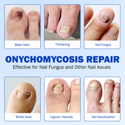 Fungal Nail Patches